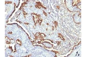 Formalin-fixed, paraffin-embedded human lung carcinoma stained with Cytokeratin 7 antibody (KRT7/760 + OV-TL12/30)