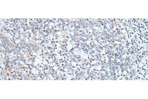 Immunohistochemistry of paraffin-embedded Human tonsil tissue using ABCD1 Polyclonal Antibody at dilution of 1:80(x200) (ABCD1 anticorps)