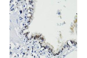 Immunohistochemistry of paraffin-embedded Human lung using Phospho-Stat3(S727) Polyclonal Antibody at dilution of 1:100 (40x lens).