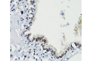 Immunohistochemistry of paraffin-embedded Human lung using Phospho-Stat3(S727) Polyclonal Antibody at dilution of 1:100 (40x lens). (STAT3 anticorps  (pSer727))
