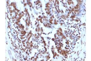 Formalin-fixed, paraffin-embedded human Ovarian Carcinoma stained with Histone H1 Mouse Monoclonal Antibody (1415-1)