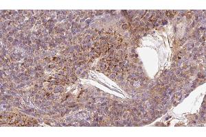 ABIN6273055 at 1/100 staining Human lymph cancer tissue by IHC-P. (MAVS anticorps  (C-Term))