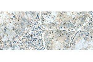Immunohistochemistry of paraffin-embedded Human colorectal cancer tissue using PAK1IP1 Polyclonal Antibody at dilution of 1:120(x200) (PAK1IP1 anticorps)
