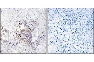 Immunohistochemistry analysis of paraffin-embedded human lung carcinoma tissue, using CHML Antibody. (CHML anticorps  (AA 128-177))