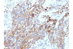 Formalin-fixed, paraffin-embedded human Lung Carcinoma stained with CD56 Mouse Monoclonal Antibody (NCAM1/795). (CD56 anticorps)