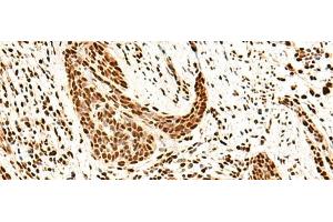 Immunohistochemistry of paraffin-embedded Human esophagus cancer tissue using SNRPB2 Polyclonal Antibody at dilution of 1:75(x200) (SNRPB2 anticorps)