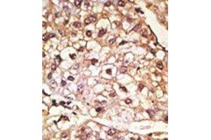 Formalin-fixed and paraffin-embedded human cancer tissue reacted with the primary antibody, which was peroxidase-conjugated to the secondary antibody, followed by AEC staining. (SNCA anticorps  (C-Term))