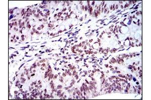 Immunohistochemical analysis of paraffin-embedded rectum cancer tissues using BMI1 mouse mAb with DAB staining.