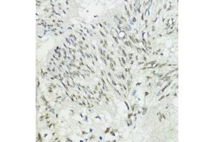 Immunohistochemistry of paraffin-embedded human gastric cancer using ZEB1 antibody (ABIN1513705, ABIN3022026, ABIN3022027 and ABIN6218575) at dilution of 1:200 (40x lens).