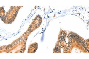 Immunohistochemistry of paraffin-embedded Human colon cancer tissue using ACOX3 Polyclonal Antibody at dilution 1:35 (ACOX3 anticorps)