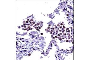 TLR8 Antibody (Center) ((ABIN657933 and ABIN2846877))immunohistochemistry analysis in formalin fixed and paraffin embedded human lung tissue followed by peroxidase conjugation of the secondary antibody and DAB staining. (TLR8 anticorps  (AA 434-463))