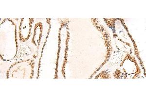 Immunohistochemistry of paraffin-embedded Human thyroid cancer tissue using DCAF10 Polyclonal Antibody at dilution of 1:130(x200) (DCAF10 anticorps)