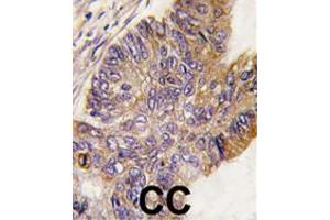 Formalin-fixed and paraffin-embedded human colon carcinoma tissue reacted with RPS6KA1 polyclonal antibody  , which was peroxidase-conjugated to the secondary antibody, followed by DAB staining. (RPS6KA1 anticorps  (Ser732))