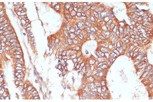 Immunohistochemistry of paraffin-embedded Human colon carcinoma using PTPRN2 Polyclonal Antibody at dilution of 1:100 (40x lens).