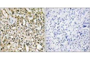 Immunohistochemistry analysis of paraffin-embedded human liver carcinoma tissue, using MYC Antibody. (c-MYC anticorps  (AA 386-435))