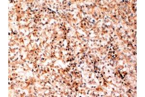 ABIN184741 (2 µg/mL) staining of paraffin embedded Human Kidney cancer. (TFEB anticorps  (N-Term))