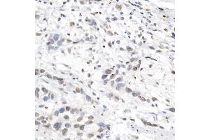 Immunohistochemistry of paraffin-embedded human esophageal cancer using [KO Validated] L3MBTL3 Rabbit pAb (ABIN6132145, ABIN6143061, ABIN6143062 and ABIN6223119) at dilution of 1:50 (40x lens). (L3MBTL3 anticorps  (AA 1-230))