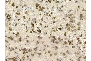 ABIN6260720 and ABIN6276822 at 1/100 staining human melanoma by IHC-P. (CDK7 anticorps  (Internal Region))