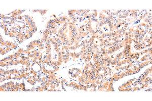 Immunohistochemistry of paraffin-embedded Human thyroid cancer tissue using Ephrin A1 Polyclonal Antibody at dilution 1:37 (Ephrin A1 anticorps)