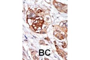 Formalin-fixed and paraffin-embedded human cancer tissue reacted with the primary antibody, which was peroxidase-conjugated to the secondary antibody, followed by DAB staining.
