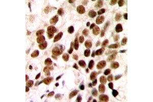 Immunohistochemical analysis of GTF2H1 staining in human breast cancer formalin fixed paraffin embedded tissue section.