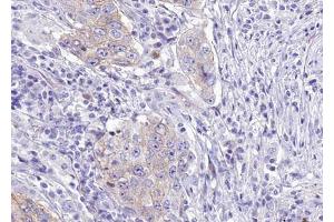 ABIN6267692 at 1/100 staining human Lung carcinoma tissue sections by IHC-P.