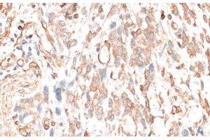 Immunohistochemistry of paraffin-embedded Human gastric cancer using CDH11 Polyclonal Antibody at dilution of 1:100 (40x lens). (OB Cadherin anticorps)