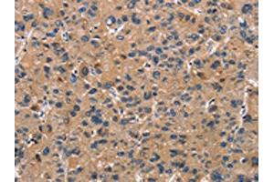 The image on the left is immunohistochemistry of paraffin-embedded Human liver cancer tissue using ABIN7189936(ATP7A Antibody) at dilution 1/50, on the right is treated with synthetic peptide. (ATP7A anticorps)