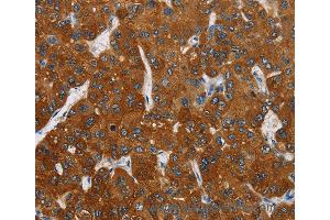 Immunohistochemistry of Human thyroid cancer using CARD9 Polyclonal Antibody at dilution of 1:70