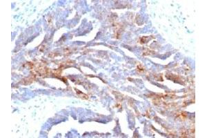 IHC staining of human ovarian carcinoma with TAG-72 antibody