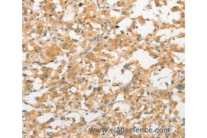 Immunohistochemistry of Human liver cancer using TLR3 Polyclonal Antibody at dilution of 1:40