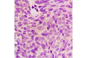 Immunohistochemical analysis of STMN1 staining in human breast cancer formalin fixed paraffin embedded tissue section.
