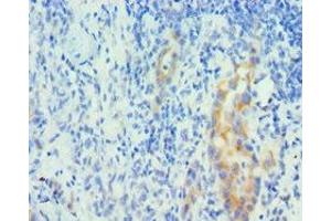 Immunohistochemistry of paraffin-embedded human lung cancer using ABIN7150963 at dilution of 1:100