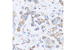 Immunohistochemistry of paraffin-embedded human breast cancer using C antibody (ABIN7266074) at dilution of 1:100 (40x lens).