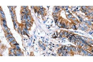 Immunohistochemistry of paraffin-embedded Human colon cancer using Claudin 7 Polyclonal Antibody at dilution of 1:50