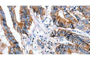 Immunohistochemistry of paraffin-embedded Human colon cancer using Claudin 7 Polyclonal Antibody at dilution of 1:50 (Claudin 7 anticorps)