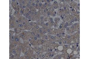 ABIN6267439 at 1/200 staining human liver cancer tissue sections by IHC-P. (RPS6KB1 anticorps  (pThr389, pThr412))