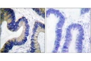 Immunohistochemistry analysis of paraffin-embedded human colon carcinoma, using 4E-BP1 (Phospho-Ser64) Antibody.
