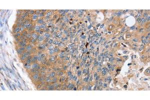 Immunohistochemistry of paraffin-embedded Human esophagus cancer using REG3A Polyclonal Antibody at dilution of 1:40 (REG3A anticorps)