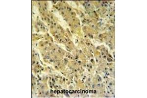 PSG7 Antibody (C-term) (ABIN651132 and ABIN2840089) IHC analysis in formalin fixed and paraffin embedded hepatocarcinoma followed by peroxidase conjugation of the secondary antibody and DAB staining. (PSG7 anticorps  (C-Term))