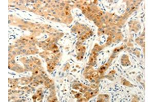 The image on the left is immunohistochemistry of paraffin-embedded Human lung cancer tissue using ABIN7190632(FAT4 Antibody) at dilution 1/20, on the right is treated with synthetic peptide. (FAT4 anticorps)