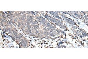 Immunohistochemistry of paraffin-embedded Human thyroid cancer tissue using UPK3A Polyclonal Antibody at dilution of 1:30(x200) (Uroplakin 3A anticorps)