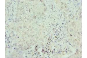 Immunohistochemistry of paraffin-embedded human lung cancer using ABIN7168762 at dilution of 1:100