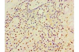 Immunohistochemistry of paraffin-embedded human breast cancer using ABIN7169355 at dilution of 1:100 (SRRT anticorps  (AA 627-876))