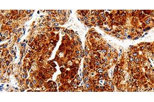 Immunohistochemistry of paraffin-embedded Human liver cancer tissue using COX19 Polyclonal Antibody at dilution 1:50 (COX19 anticorps)