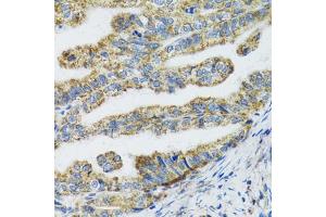 Immunohistochemistry of paraffin-embedded human gastric cancer using TXN2 antibody (ABIN5974110) at dilution of 1/100 (40x lens). (TXN2 anticorps)