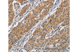 Immunohistochemistry of Human gastric cancer using COPB1 Polyclonal Antibody at dilution of 1:50 (COPB1 anticorps)
