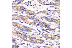 Immunohistochemistry of paraffin-embedded human colon carcinoma using TXN2 antibody at dilution of 1:100 (x40 lens). (TXN2 anticorps)
