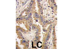 Formalin-fixed and paraffin-embedded human lung carcinoma tissue reacted with BAD polyclonal antibody  , which was peroxidase-conjugated to the secondary antibody, followed by DAB staining. (BAD anticorps  (Internal Region))