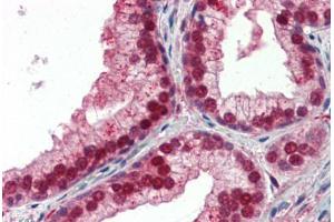 Human Prostate (formalin-fixed, paraffin-embedded) stained with NFIX antibody ABIN462183 followed by biotinylated goat anti-rabbit IgG secondary antibody ABIN481713, alkaline phosphatase-streptavidin and chromogen.